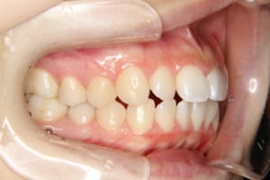 上顎前突と下顎前歯叢生が見られます
